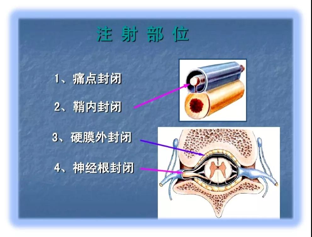 4,退变性疾病:腰椎间盘突出症,颈椎病,骨关节炎等.