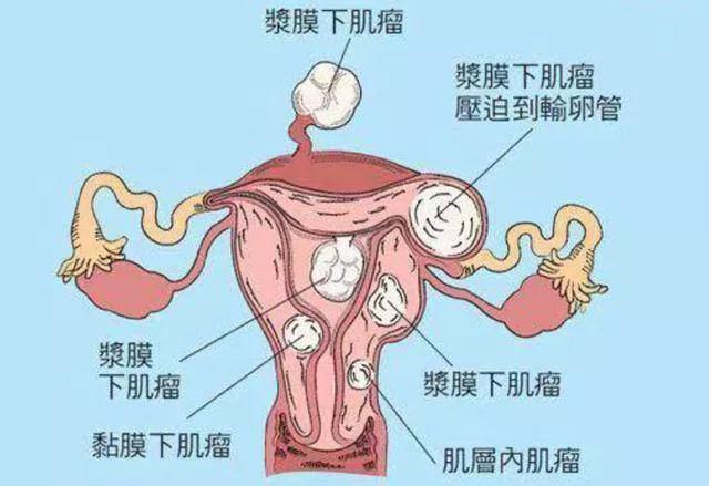 活人真能被尿憋坏,罪魁祸首竟然是子宫肌瘤