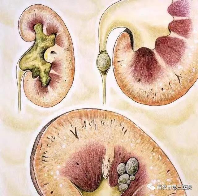 【超声科普】肾结石那些事儿