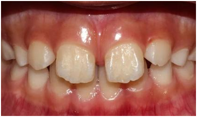潜伏在颌骨中的侧切牙恒牙胚压迫"大门牙"牙根,使其牙冠向两边"歪斜"