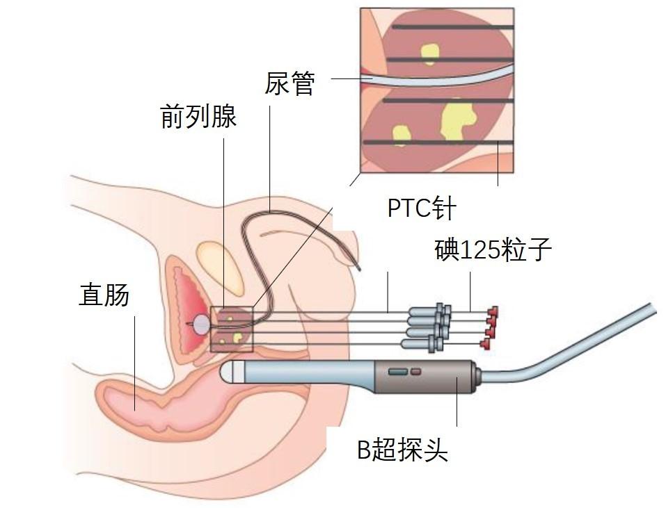 前列腺放射性碘125粒子植入术示意图