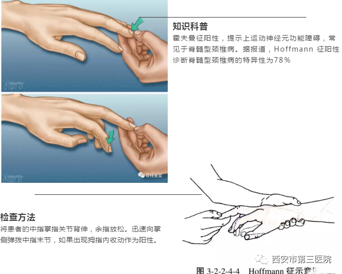 【神经脊柱外科"满月 常见脊柱手术病例分享