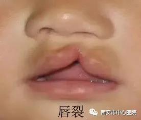 如一些发育异常情况,唇,腭裂是口腔颌面部最