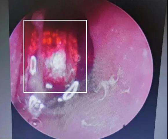鼻腔内部,白色框所示为圆型玩具豆